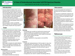 A Case of Pembrolizumab Associated SJS/TEN Spectrum Reaction
