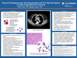 Acquired Amegakaryocytic Thrombocytopenia and Pure Red Cell Aplasia as Initial Presentation Of Thymoma by Nidhi Patel, MD and Natasha Edwin, MD