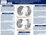 An Atypical Presentation of Metastatic Gastric Adenocarcinoma Due to Pulmonary Lymphangitic Carcinomatosis
