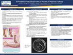Eosinophilic Fasciitis Masquerading as Myositis: A Diagnostic Challenge