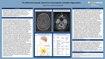 The Differential Expands: Ataxia from Paraneoplastic Cerebellar Degeneration