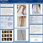 A Clot to Worry About: Venous Thromboembolism in Severe Ulcerative Colitis