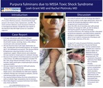 Purpura fulminans due to MSSA Toxic Shock Syndrome